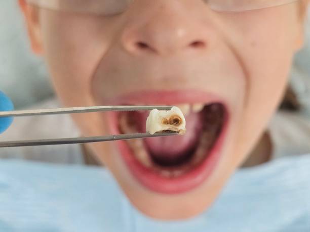 Best Broken or Cracked Tooth Emergency Dentist in Ransomville, NY